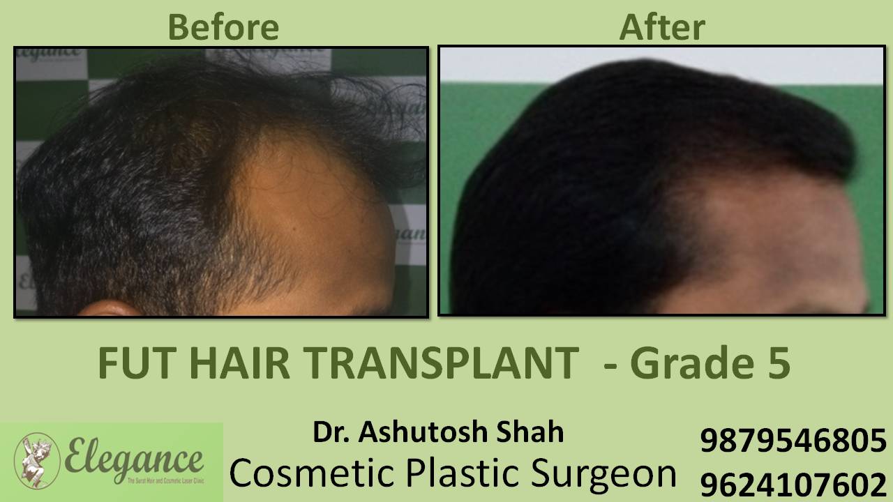 Loss Hair Treatment In Bharuch, Gujarat, India