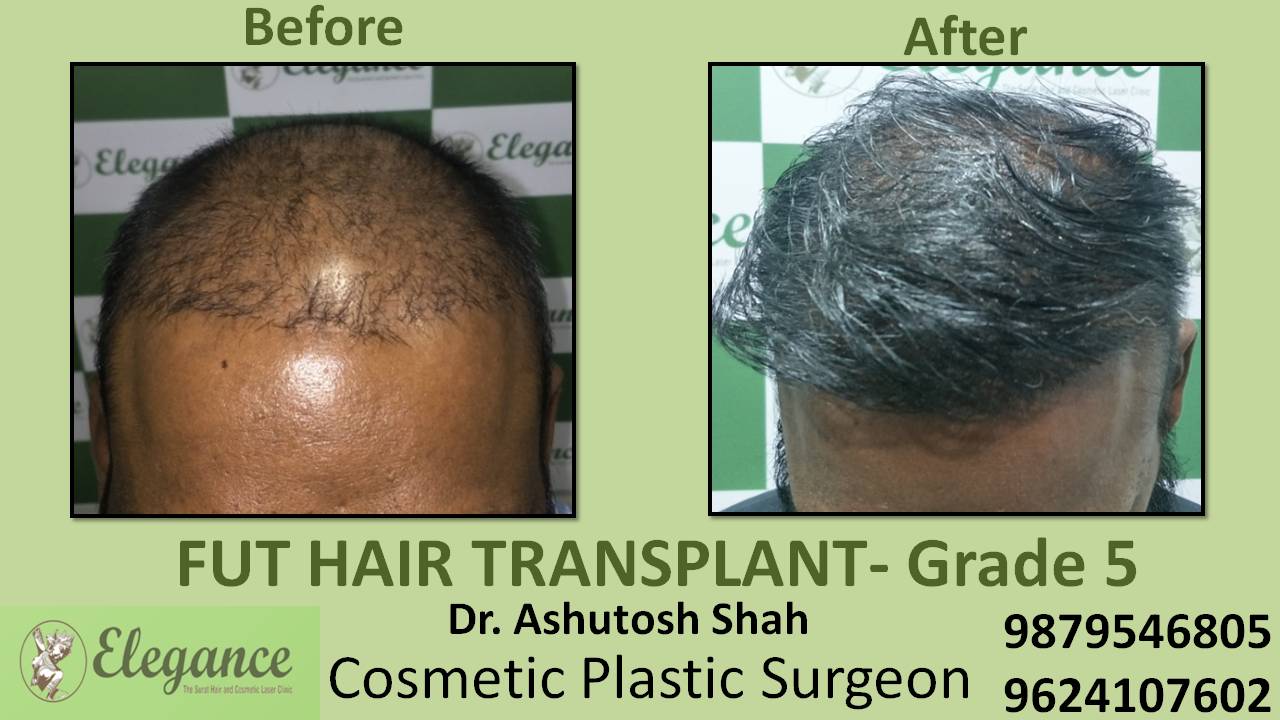 Loss Hair Treatment In Mumbai, Maharashtra, India