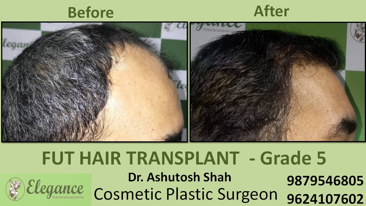 Loss Hair Treatment In Pune, Maharashtra, India