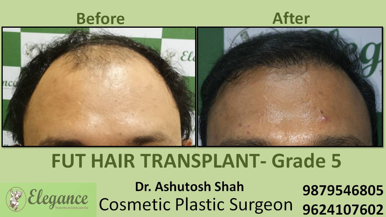 Loss Hair Treatment In Amreli, Gujarat, India