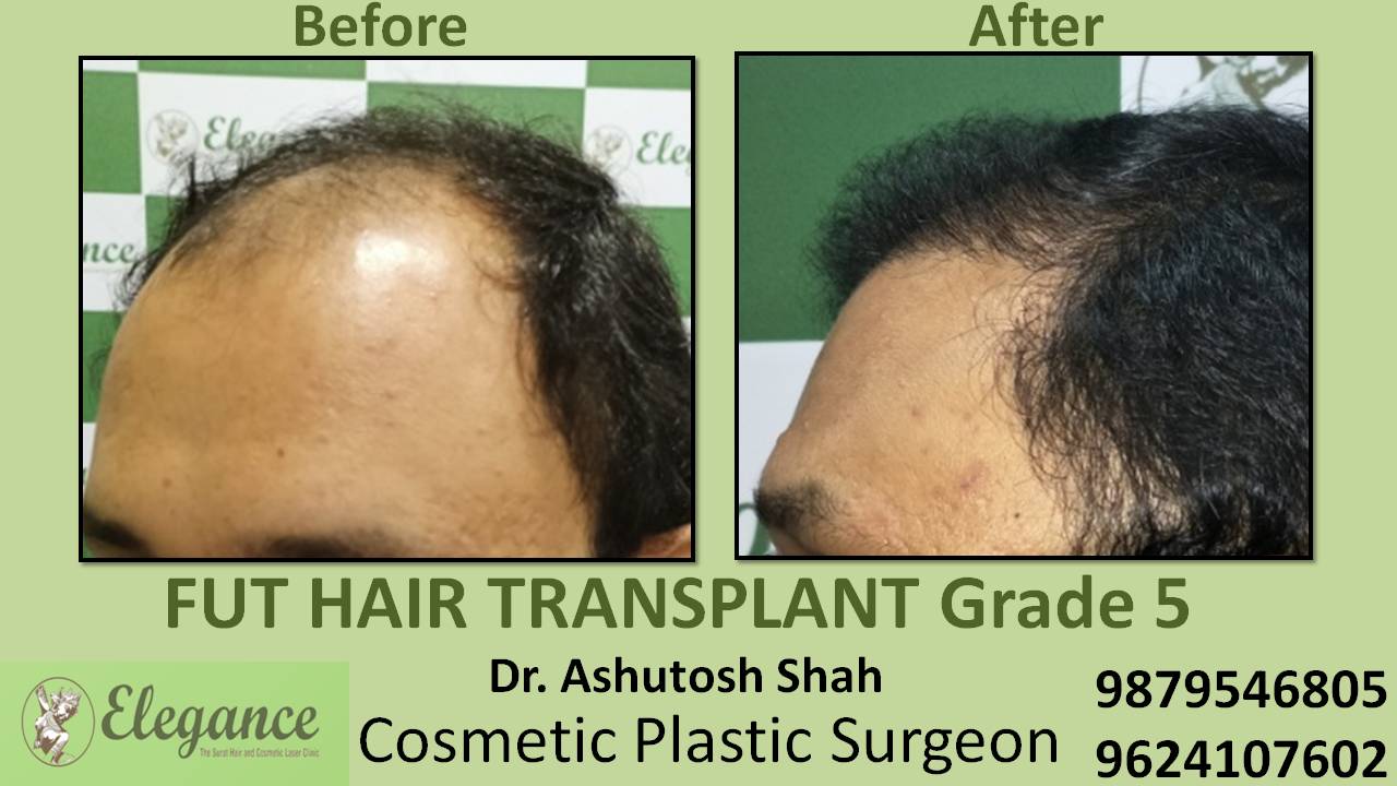 Loss Hair Treatment In Bamroli, Gujarat, India