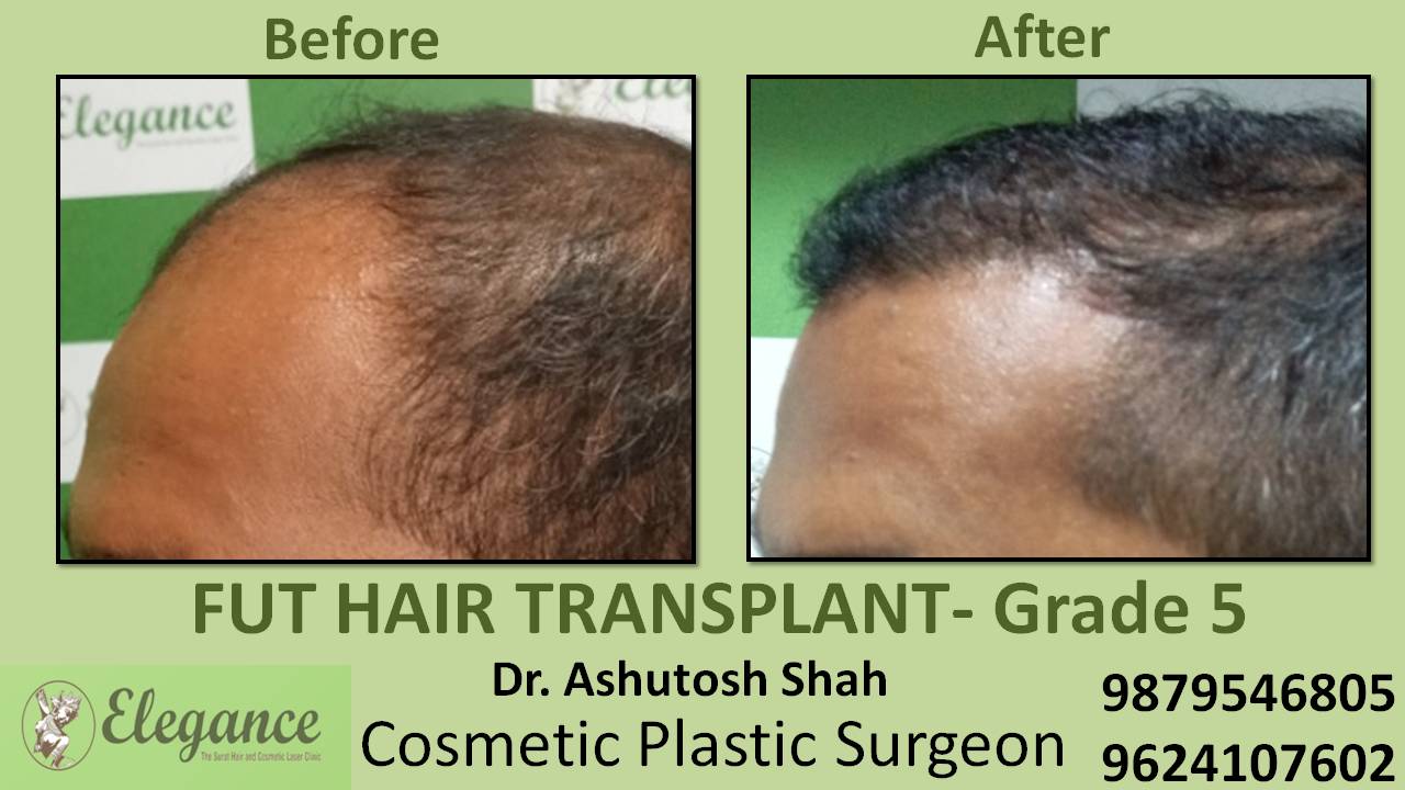 Loss Hair Treatment In Ankleshwar, Gujarat, India