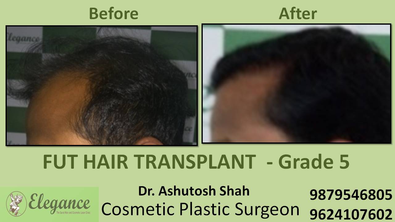 Loss Hair Treatment In Delhi, india