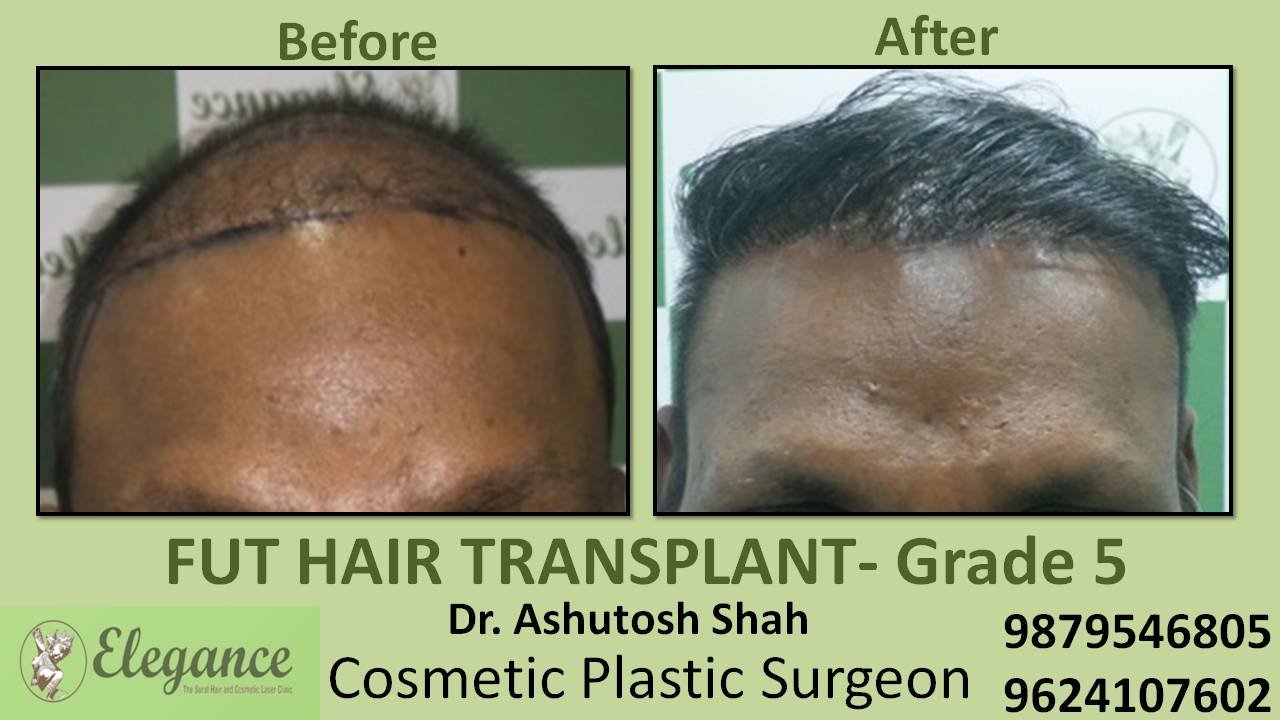 Loss Hair Treatment In Jaipur, Rajasthan, india