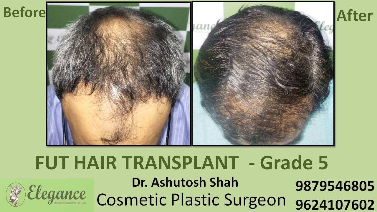 Loss Hair Treatment In Kutch, Gujarat, india
