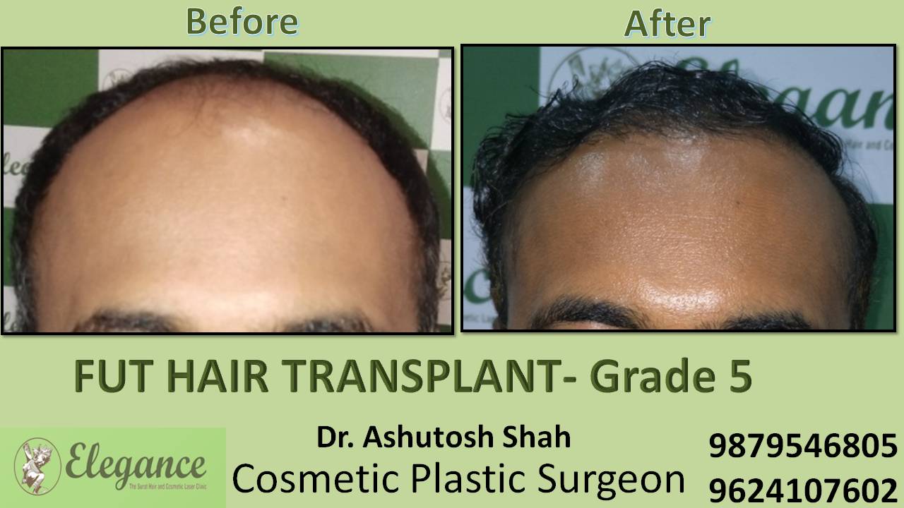 Loss Hair Treatment In Katargam, Surat, Gujarat, india