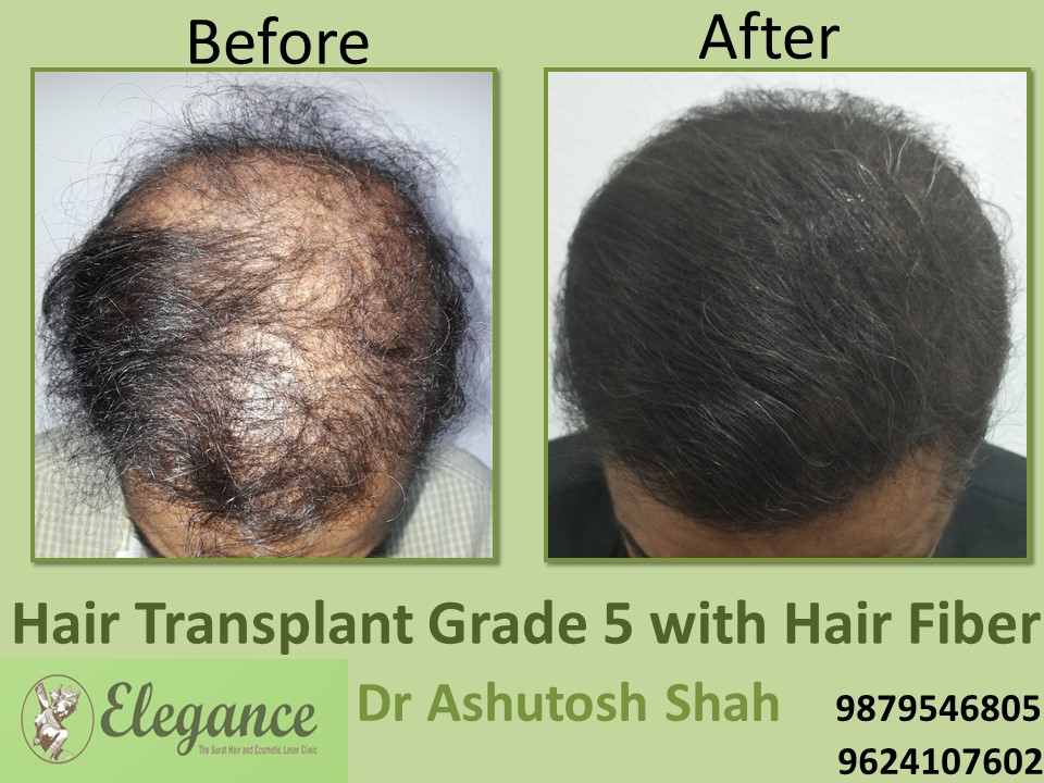 Grade 5 Hair Transplant In Bareilly, Uttar Pradesh, India