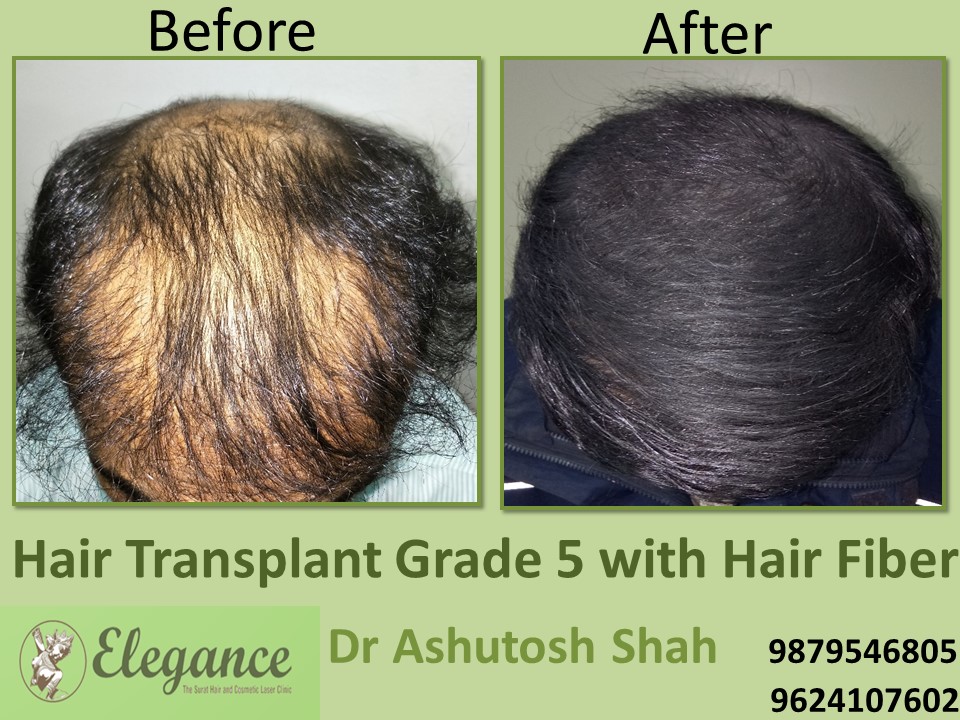 Grade 5 Hair Transplant In Aligarh, Uttar Pradesh, India