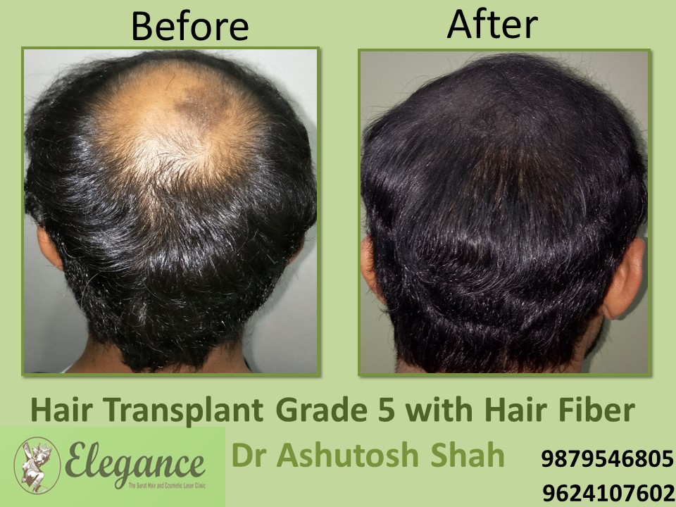 Grade 5 Hair Transplant In Tiruppur, Tamil Nadu, India
