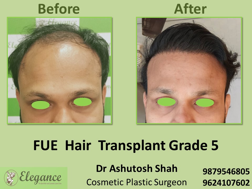 FUE Hair Transplant, Grade 5, Hair Baldness in Vesu, Surat