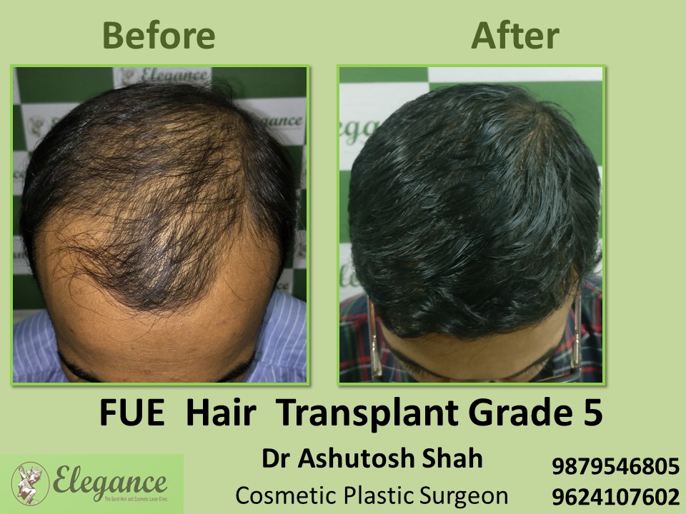 FUE Hair Transplant, Grade 5 , Hair Baldness Treatment in Vesu, Surat
