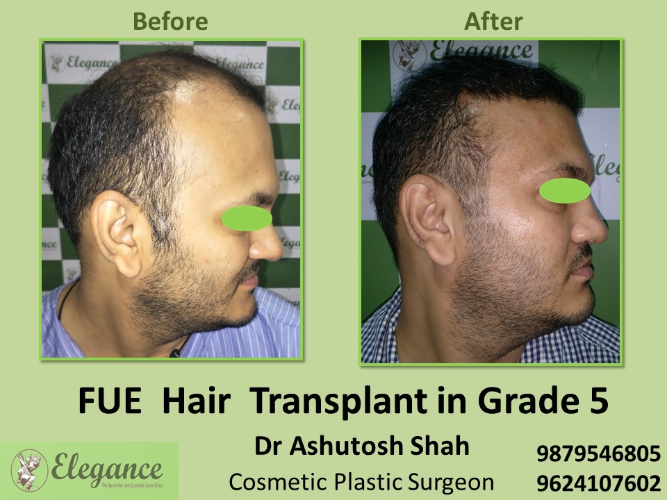 FUE Hair Transplant, Grade 5 Treatment in Vesu, Adajan, Surat