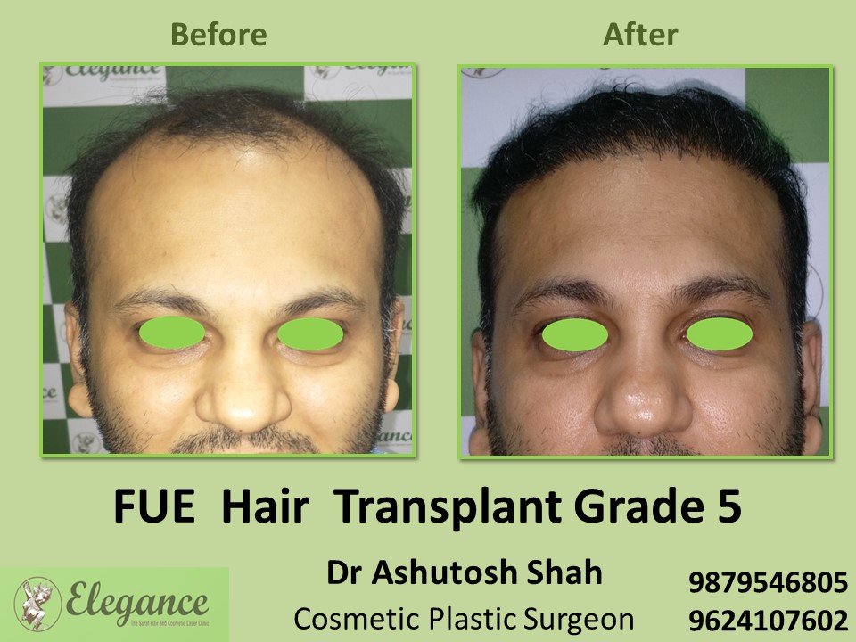 FUE Hair Transplant, Grade 5 Treatment in Vesu, Surat