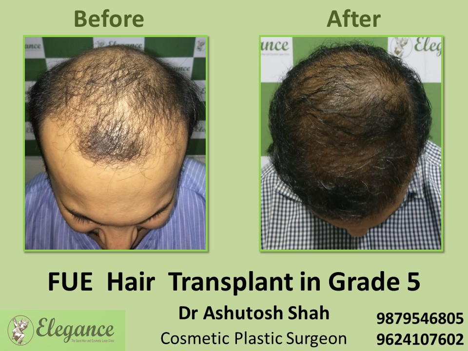 Fue Method, Hair Baldness Grade 5 Treatment in Athwagate, Vesu, Surat