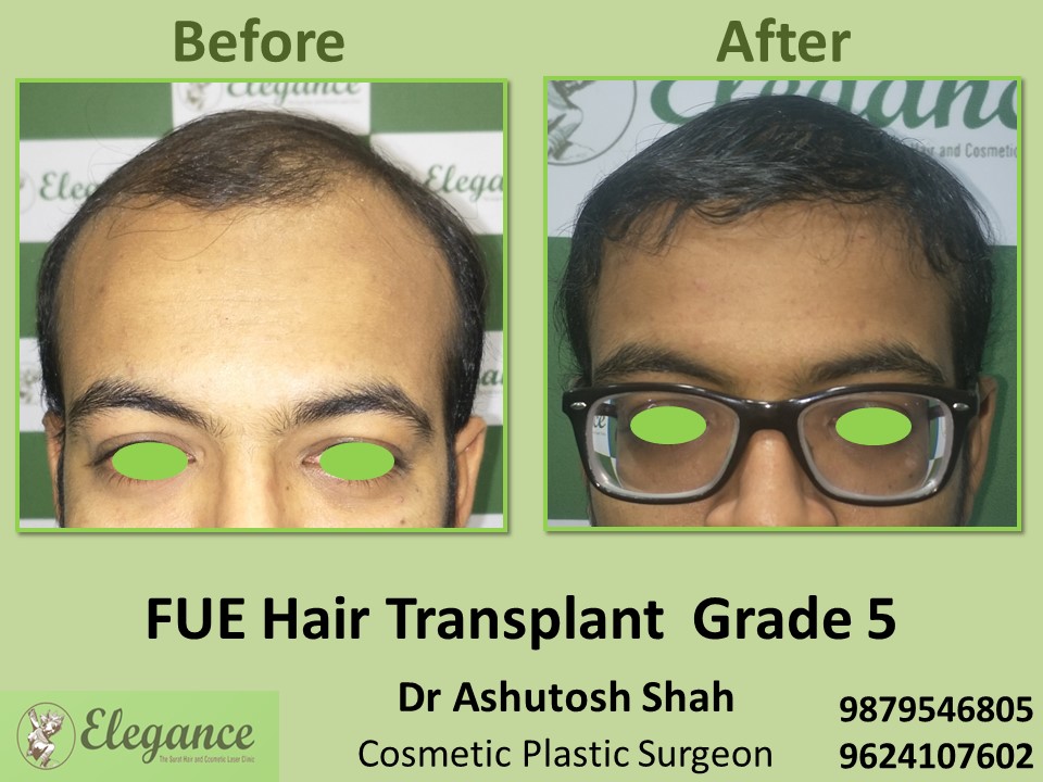 Grade 5, FUE Hair Transplant, Hair Growth Treatment in Adajan, Pal, Surat