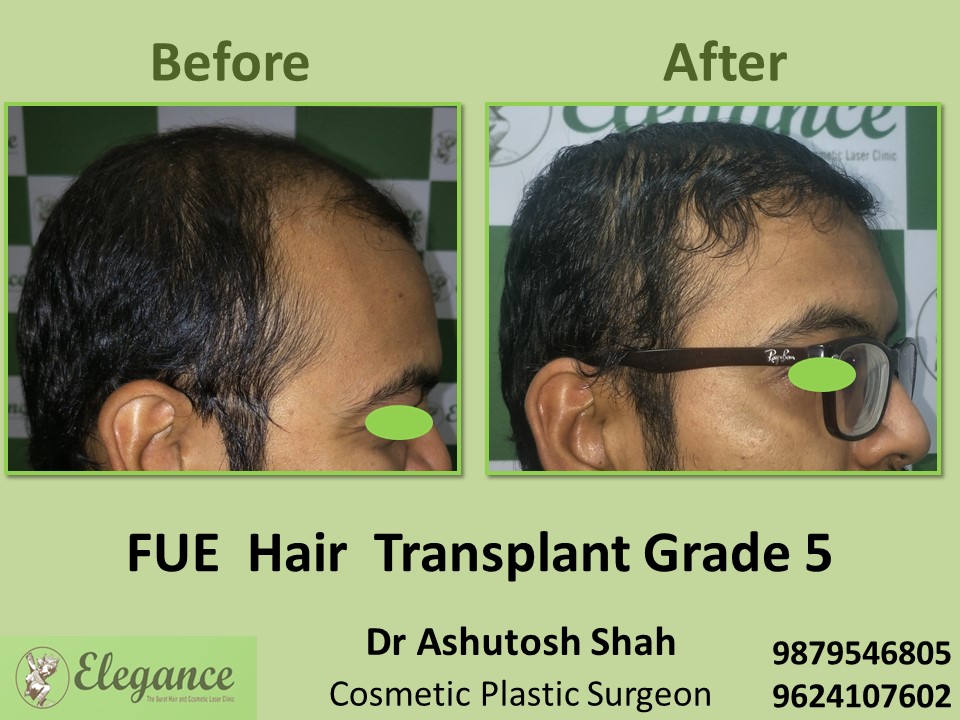 Grade 5, FUE Hair Transplant, Hair Growth Treatment in  Pal, Surat