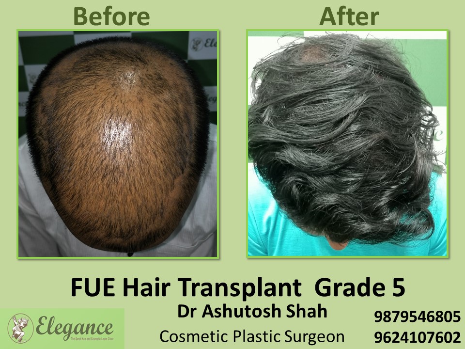 Hair Transplant, FUE Method Grade 5 in Surat