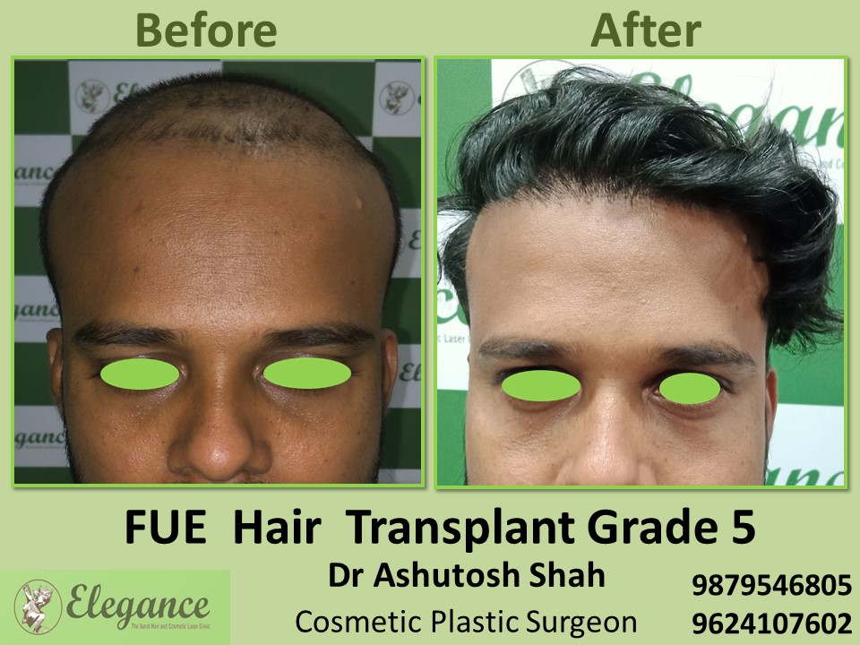 Hair Transplant, FUE Method Grade 5 in Vesu, Surat