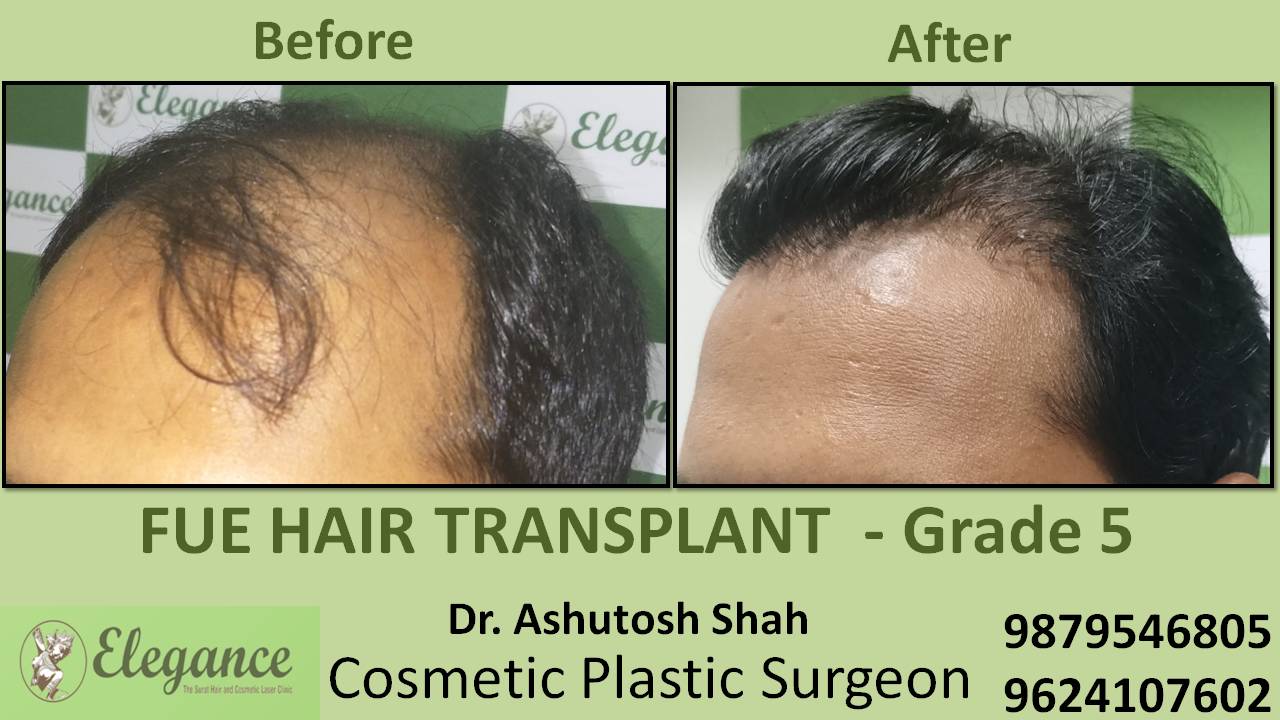 Hair Transplant Grade 5 Surat, Gujarat, India