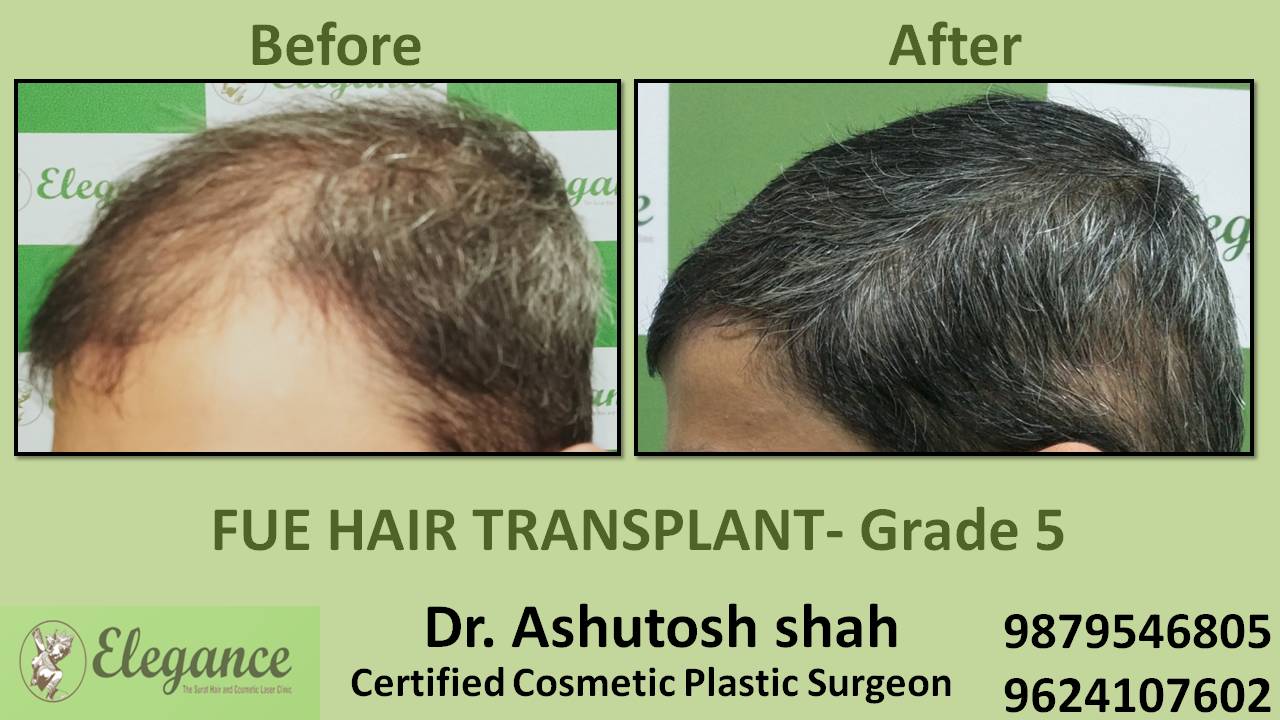 Hair Transplant Grade 5 Bharuch, Gujarat, India