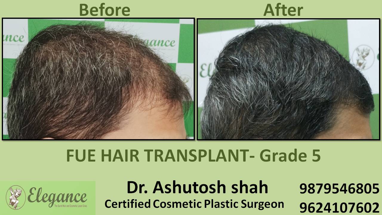 Hair Transplant Grade 5 Patan, Gujarat, India