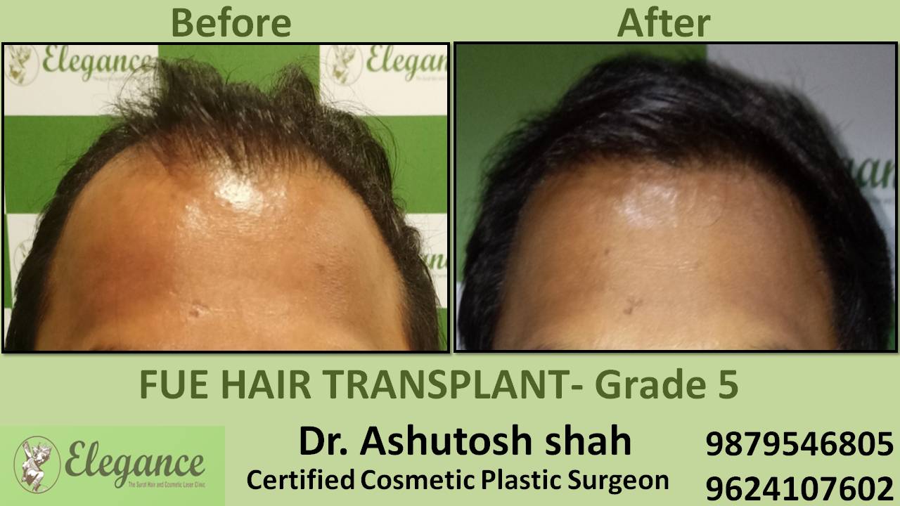 Hair Transplant Grade 5 Fadirabad, Haryana, India