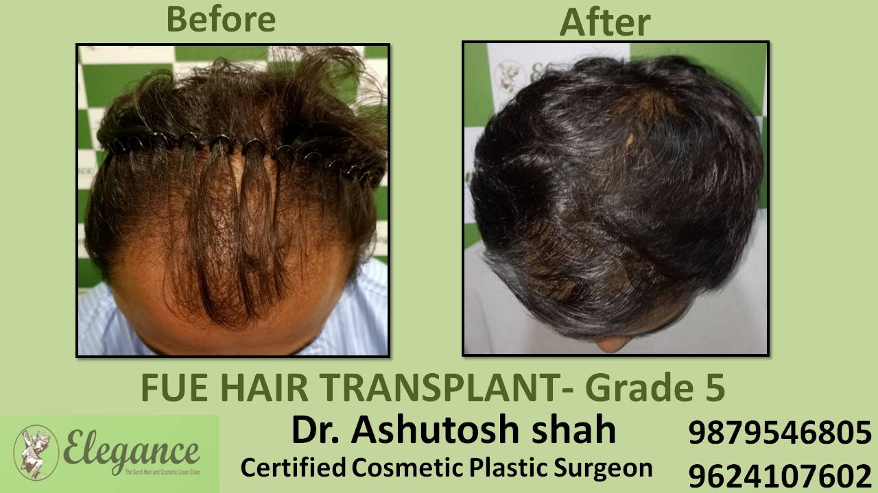 Hair Transplant Grade 5 Bardoli, Gujarat, India