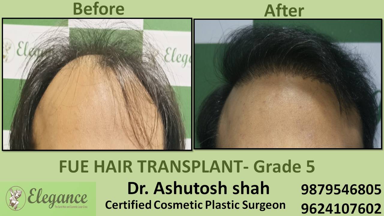Hair Transplant Grade 5 In Surat, Gujarat, India