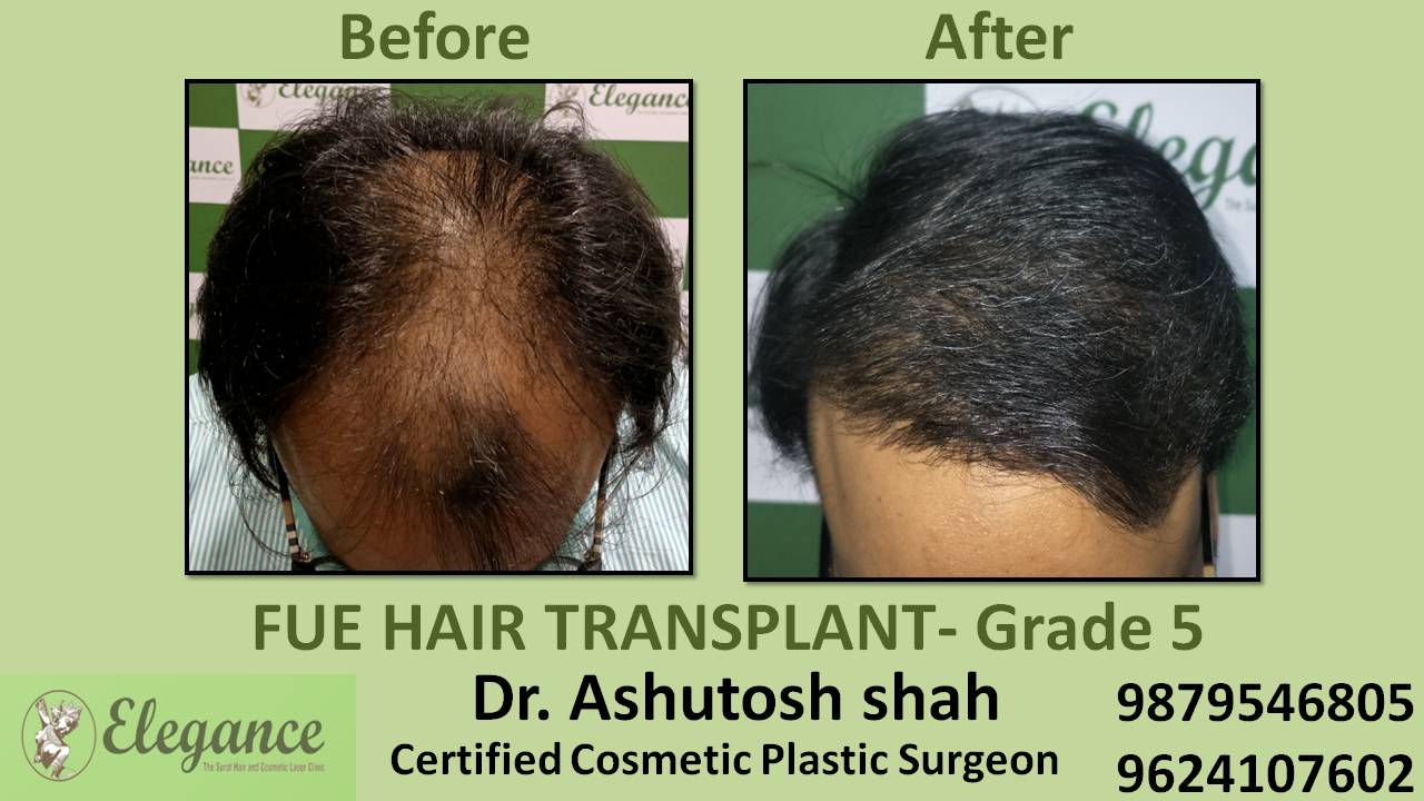 Hair Transplant Grade 5 Amroli, Surat, Gujarat, India