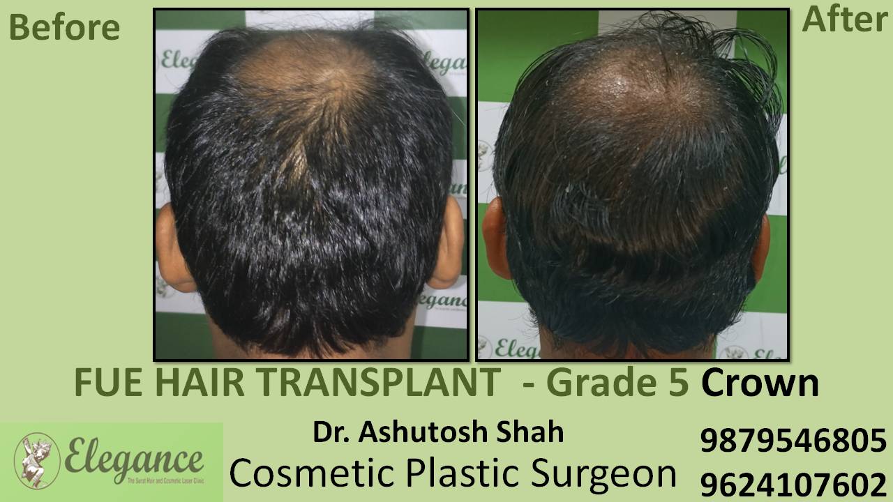 Hair Transplant Grade 5 Pune, Maharashtra, India