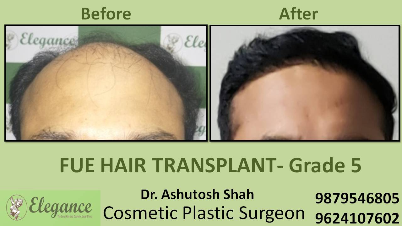 Hair Transplant Grade 5 Kota, Rajasthan, India