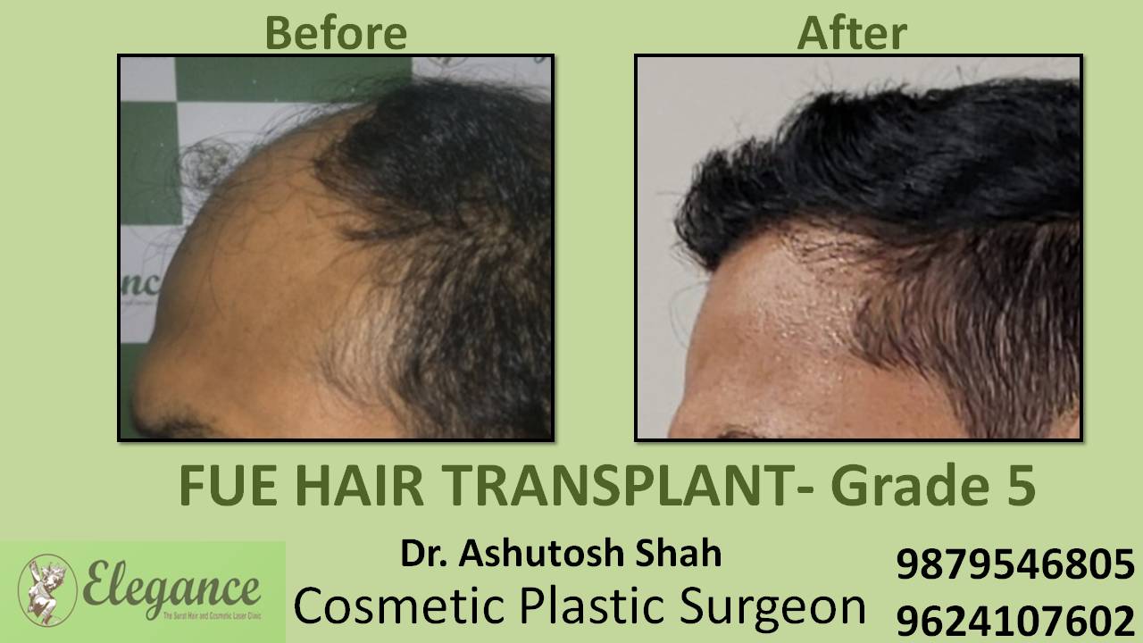Hair Transplant Grade 5 Nasik, Maharashtra, India