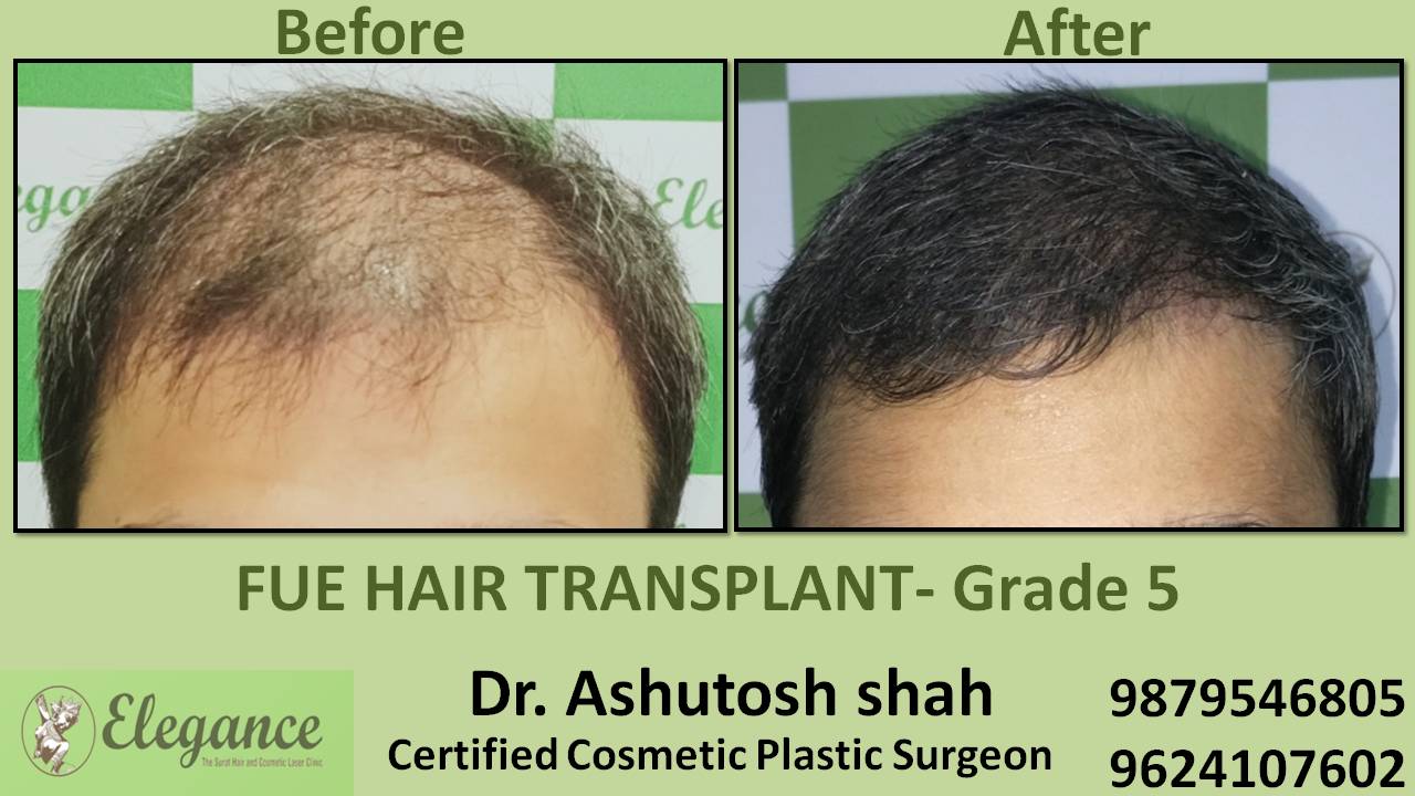 Hair Transplant Grade 5 Mumbai, Maharashtra, India