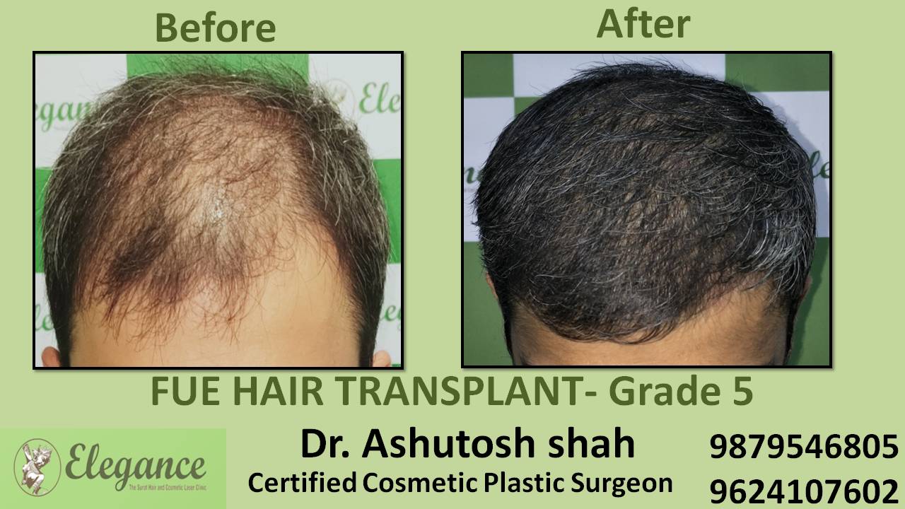 Hair Transplant Grade 5 Magdalla, Surat, Gujarat, India