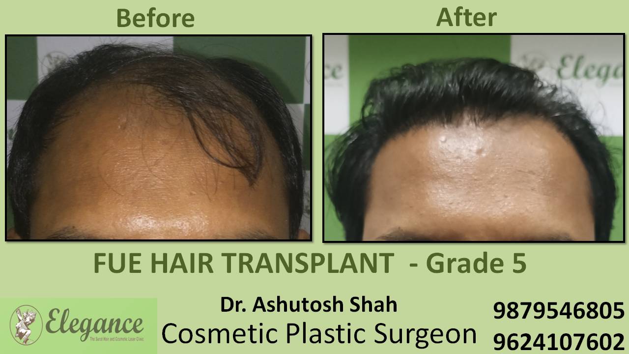 Hair Transplant Grade 5 In Diu, Gujarat, India