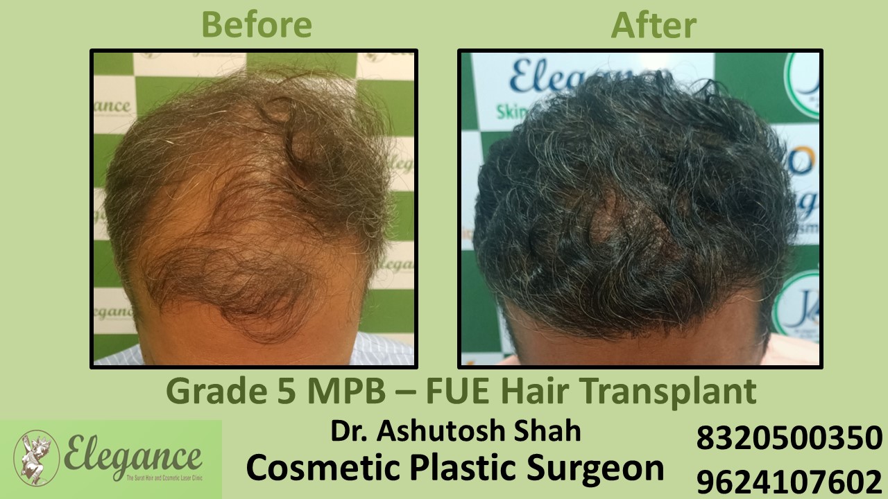 FUE Hair Transplant, Grade 5, Hair Baldness Treatment in Piplod, Surat