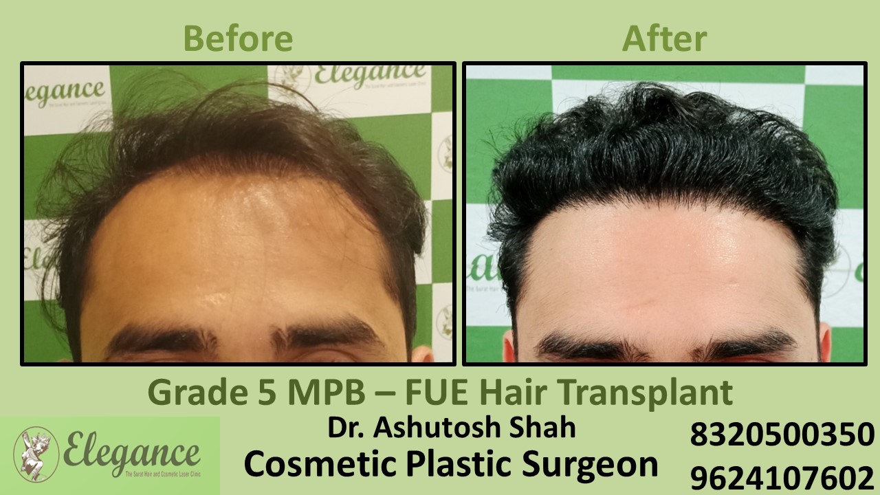 FUE Hair Transplant, Grade 5, Hair Baldness Treatment in Piplod, Vesu, Surat