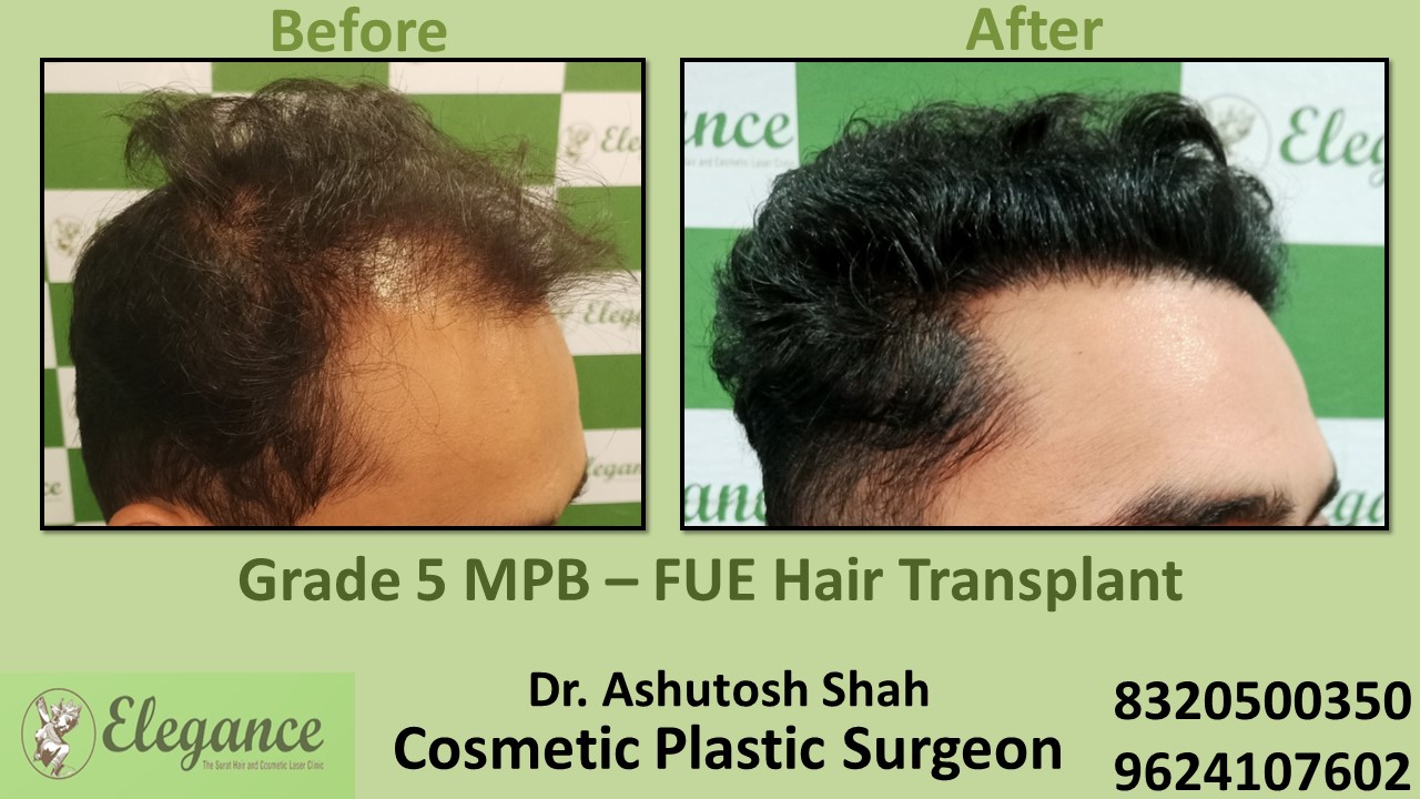 FUE Hair Transplant, Grade 5, Hair Baldness Treatment in  Vesu, Surat