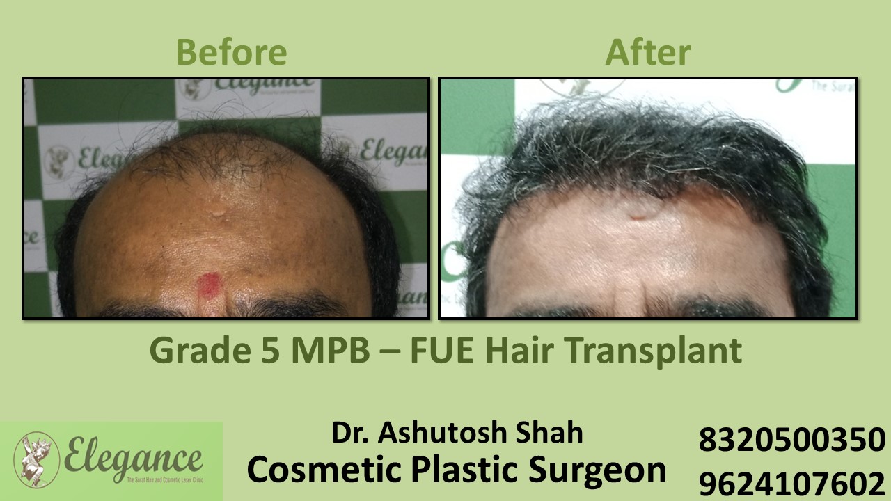 FUE Hair Transplant, Grade 5, Hair Baldness Treatment in Adajan, Surat