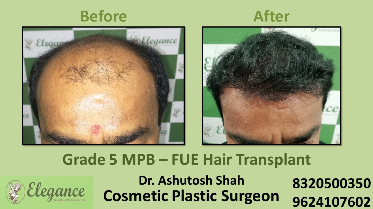 Hair Transplant, Grade 5 Treatment in Adajan, Surat