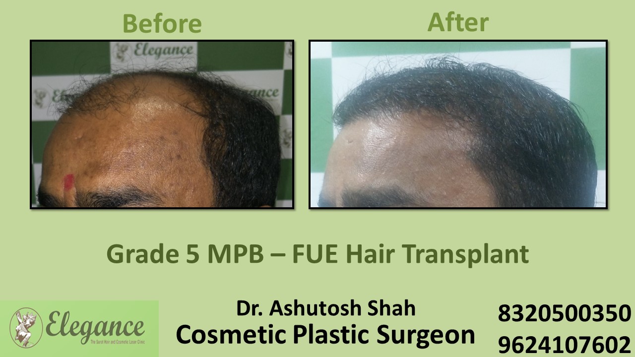 Hair Transplant, Grade 5 Treatment in Adajan, Vesu, Surat