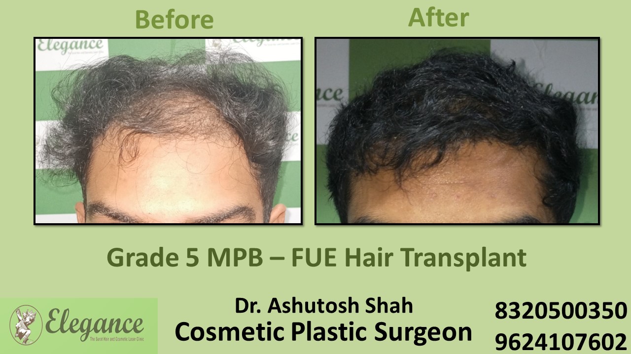 FUE Hair Transplant, Grade 5 Treatment in Rander, Surat