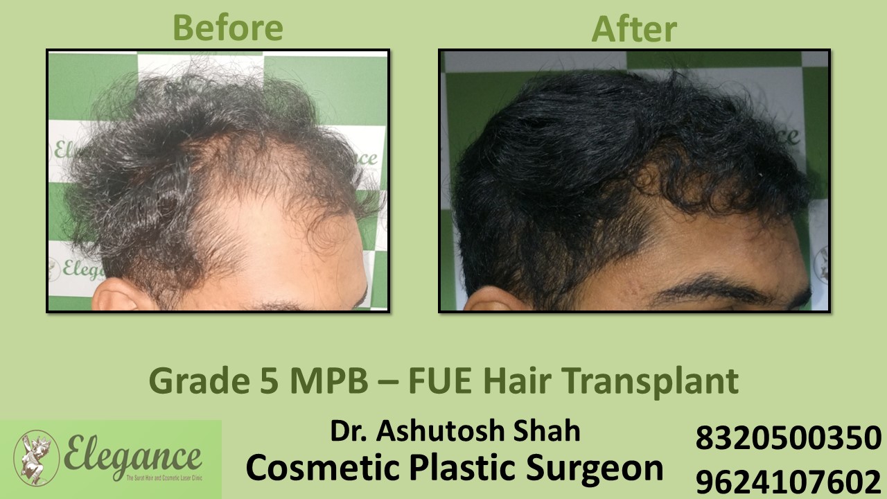 FUE Hair Transplant, Grade 5 Treatment, Hair Baldness in Rander, Surat