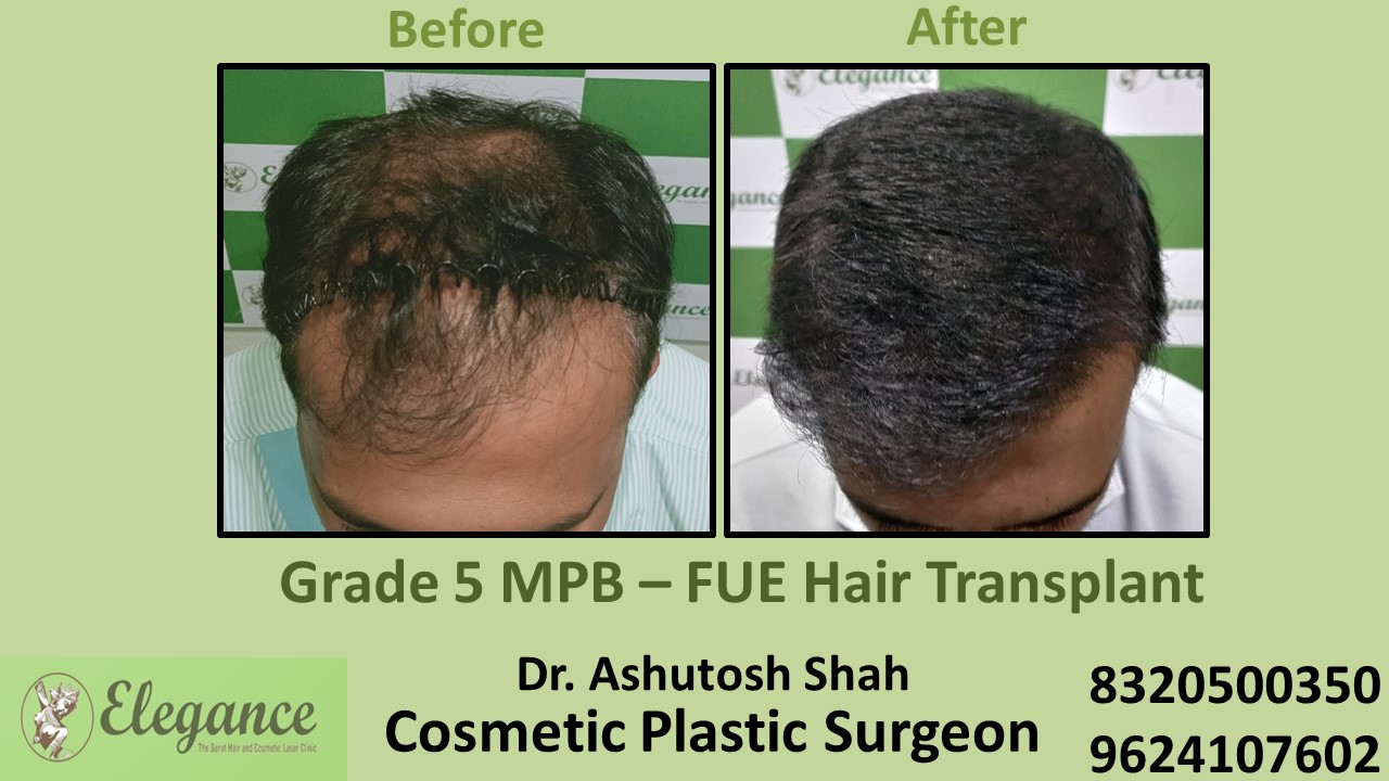 FUE Hair Transplant, Grade 5 Treatment, Hair Baldness in Adajan, Pal, Surat
