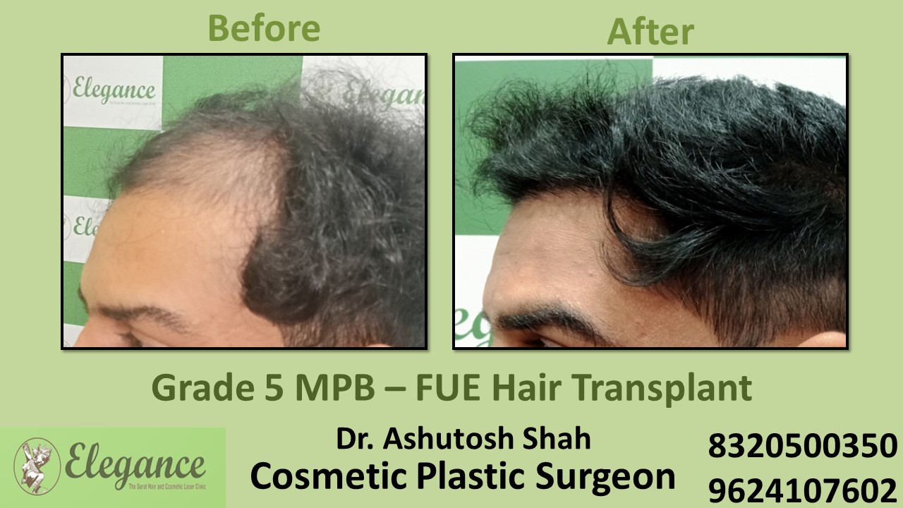 FUE Hair Transplant, Grade 5 Treatment, Hair Baldness in Pal, Surat