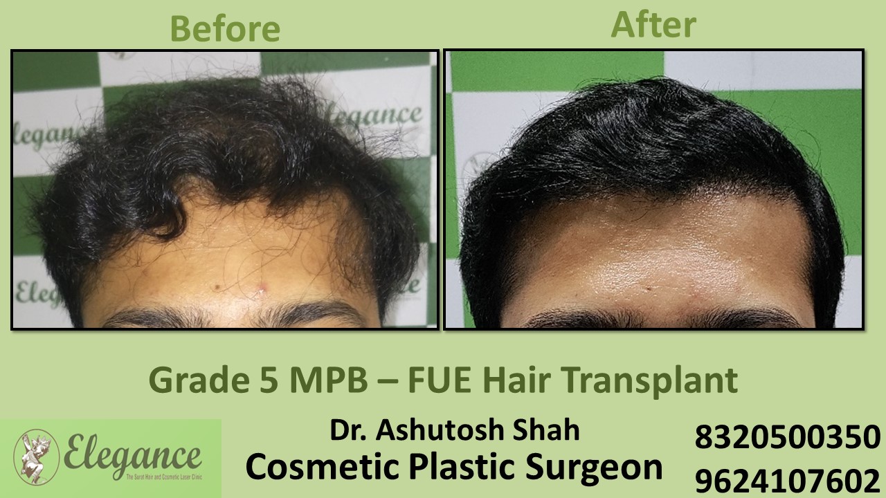 FUE Hair Transplant, Grade 5 Treatment, Hair Baldness in Athwagate, Surat