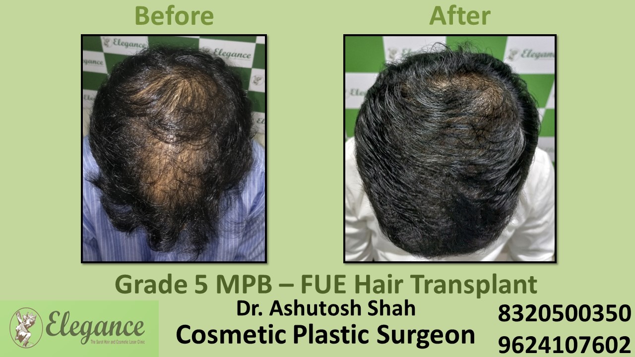Hair Baldness, Hair Growth Treatment in Vesu, Piplod, Surat
