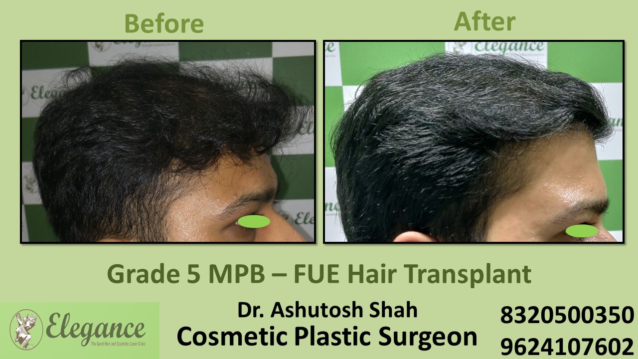 Hair Baldness, Hair Growth Treatment in  Piplod, Surat