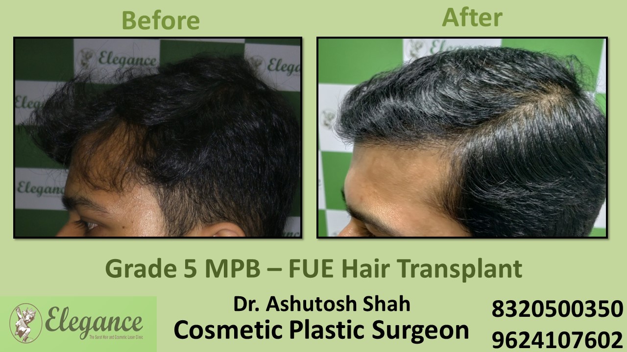 Hair Baldness, Hair Growth Treatment in Surat