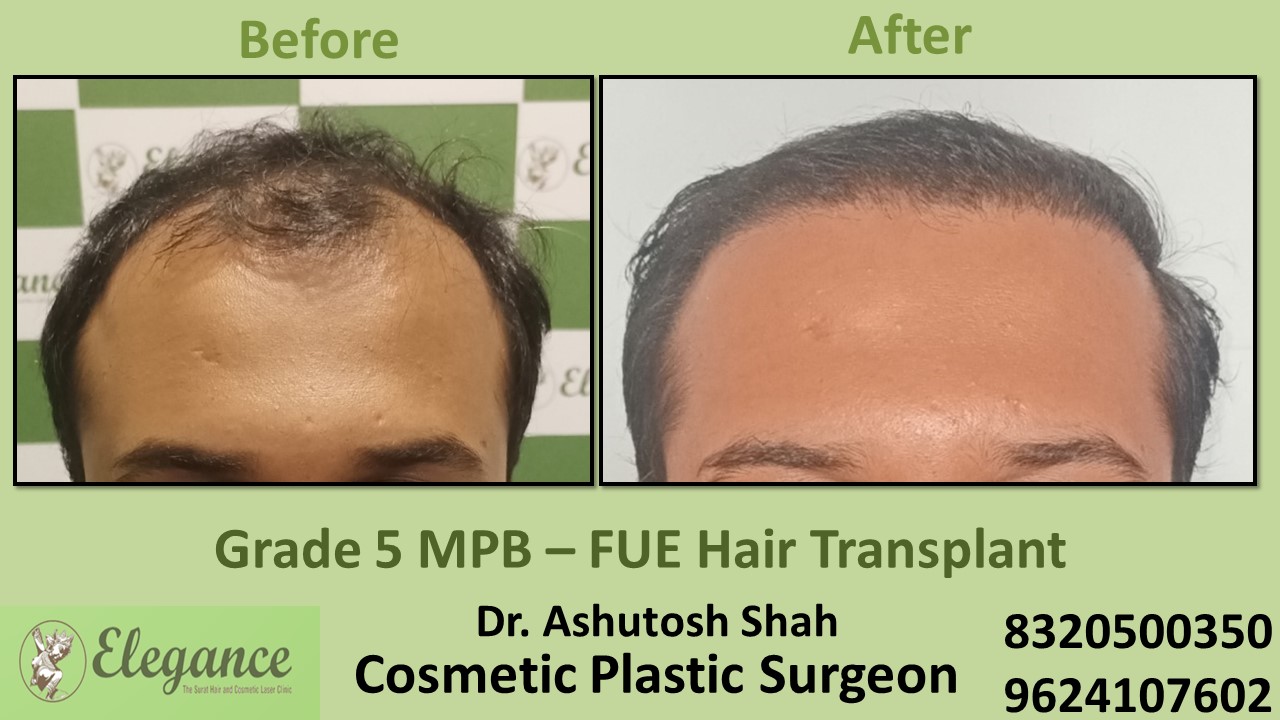 Hair Transplant Grade 5 Treatment, Hair Regrowth in Vesu, Athwagate, Surat